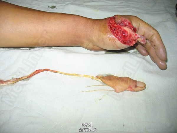 小萨遭遇拇指韧带撕脱性骨折的相关图片